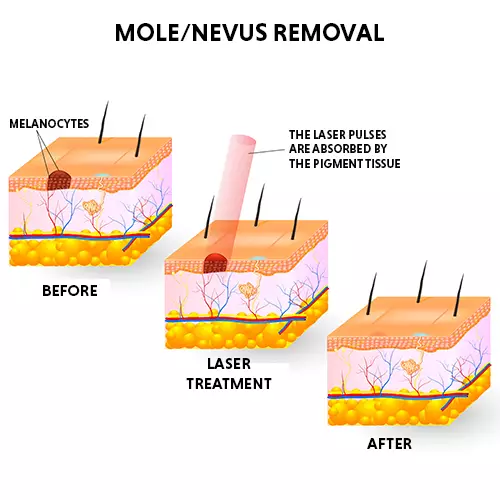 MoleRemoval Final.jpg