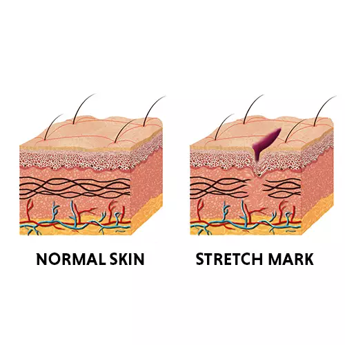 StretchMark Final.jpg