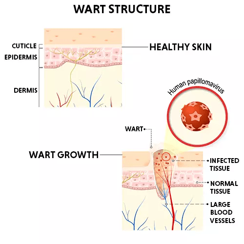 WartRemoval Final.jpg