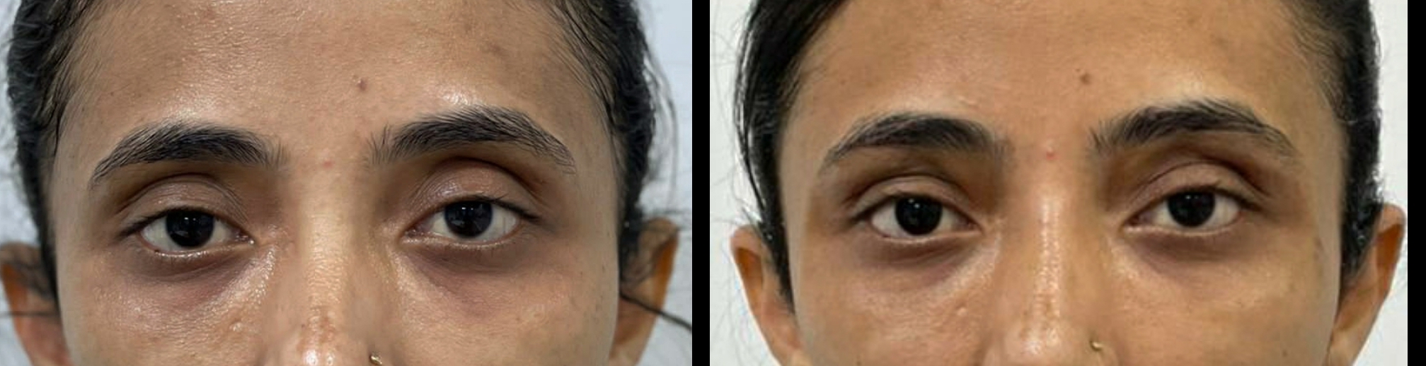 Laser Treatment For Dark Circles In Bangalore CNF