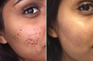 acne routine Clinic Next Face
