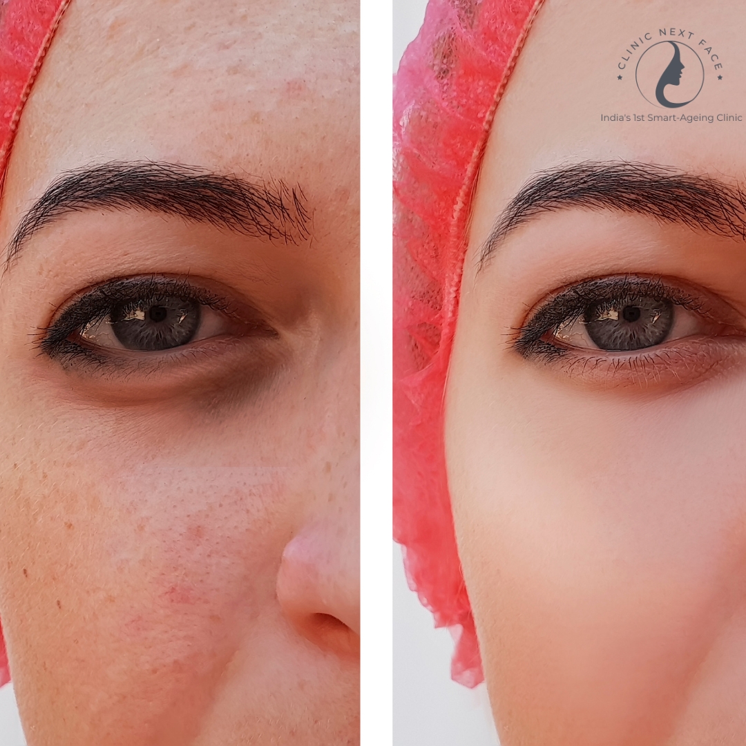 ACNE REDUCTION TREATMENT IN BANGALORE