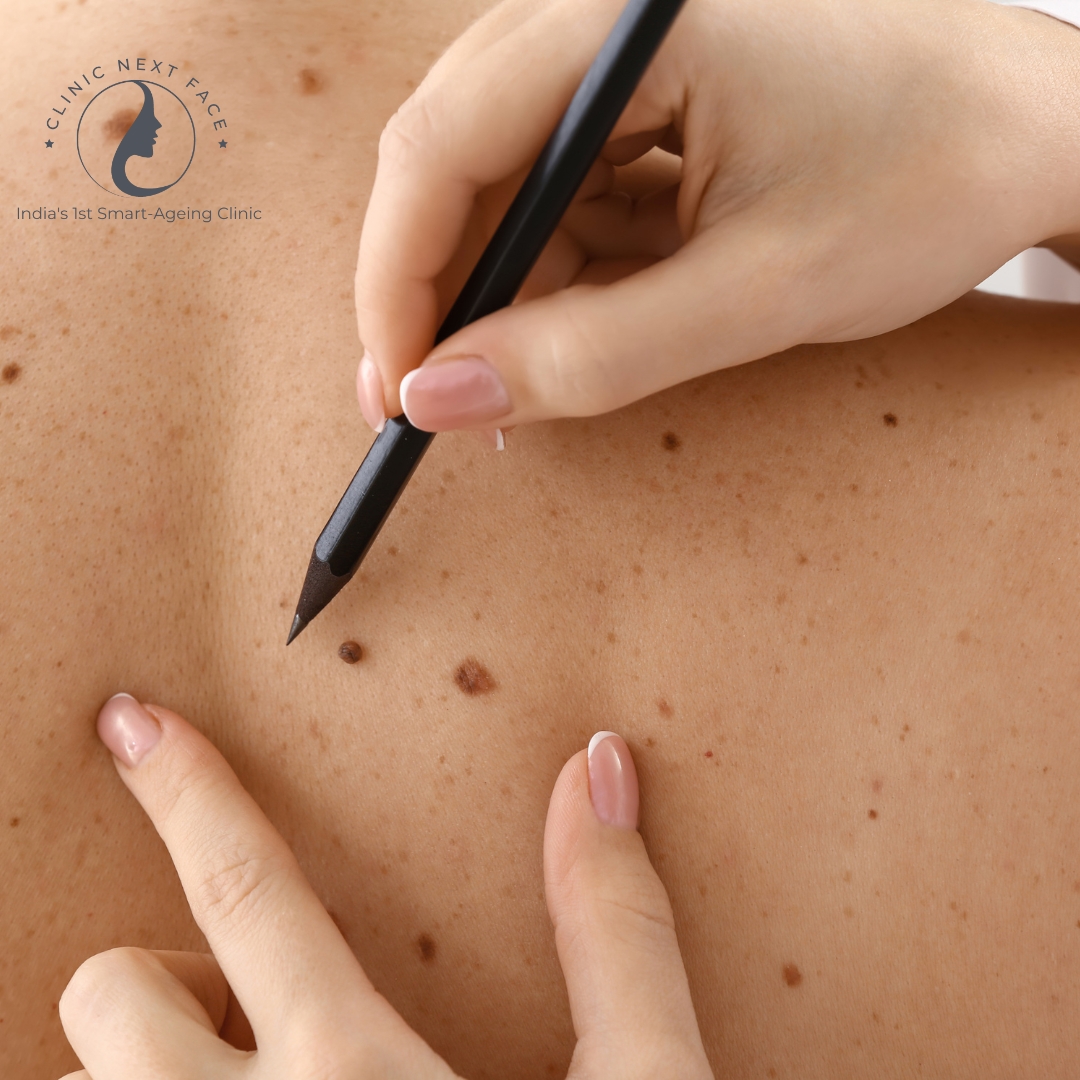 BIRTH MARK REMOVAL IN BANGALORE