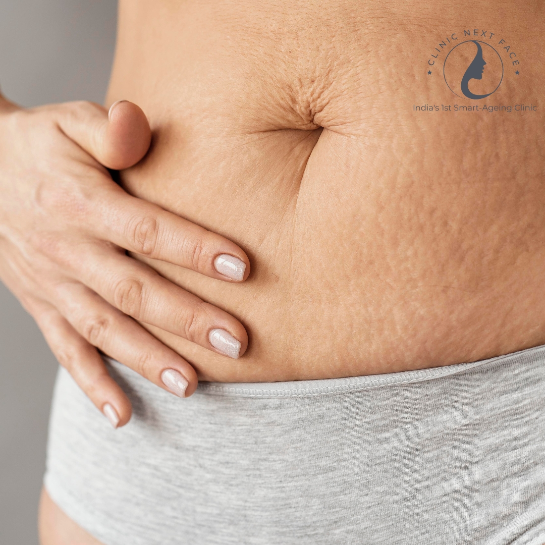 STRETCH MARKS REDUCTION IN BANGALORE