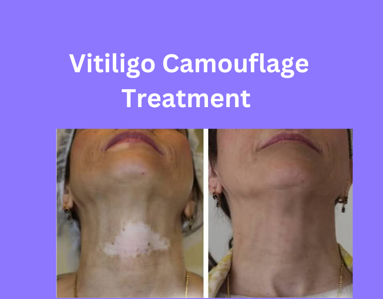 vitiligo camouflage Treatment