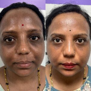 Skin whitening, jp nagar, clinic next face