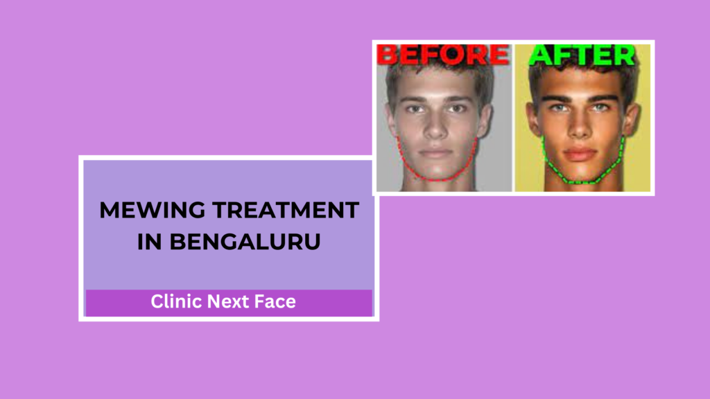 Best Mewing Treatment in Bangalore