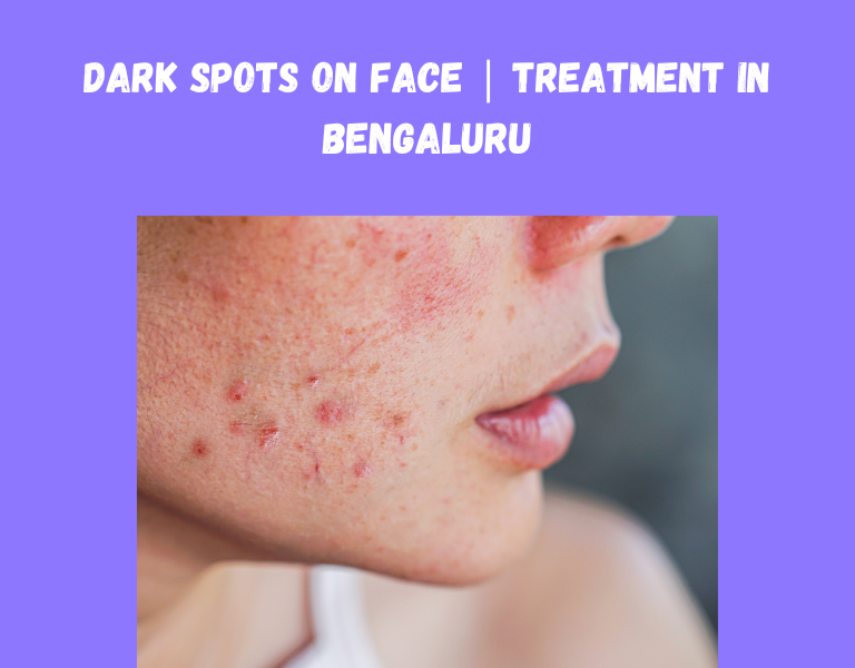 Dark Spots On Face | Treatment in Bengaluru