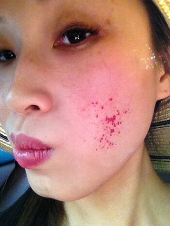 crusting and scabs after chemical peel 