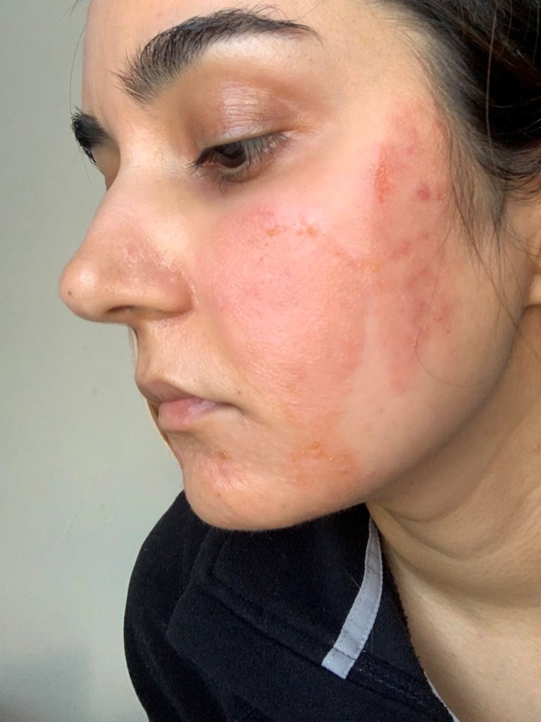 Allergies after chemical peel 