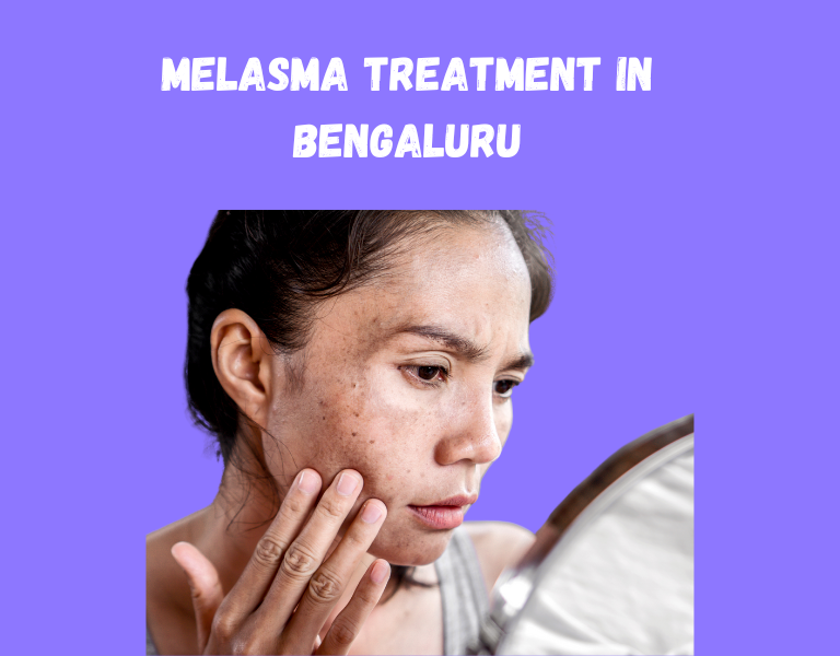 Melasma treatment in bangalore