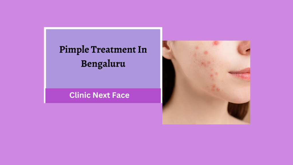 Pimple Treatment in Bangalore