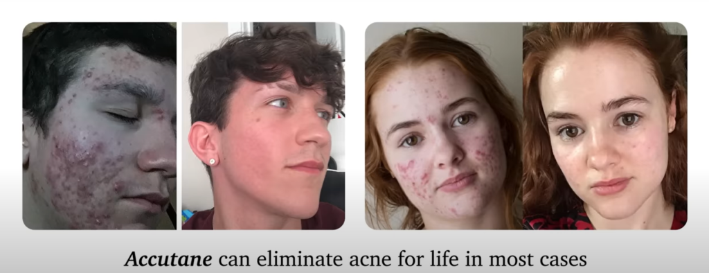 accutane can eleiminate acne for life in more cases
