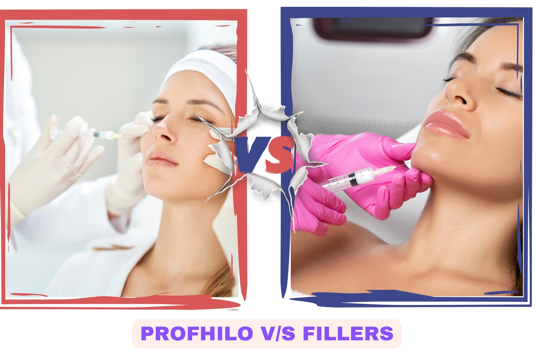 Profhilo Vs Fillers