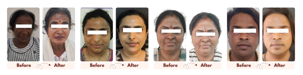Pigmentation Removal Treatments 31 Befor After 1