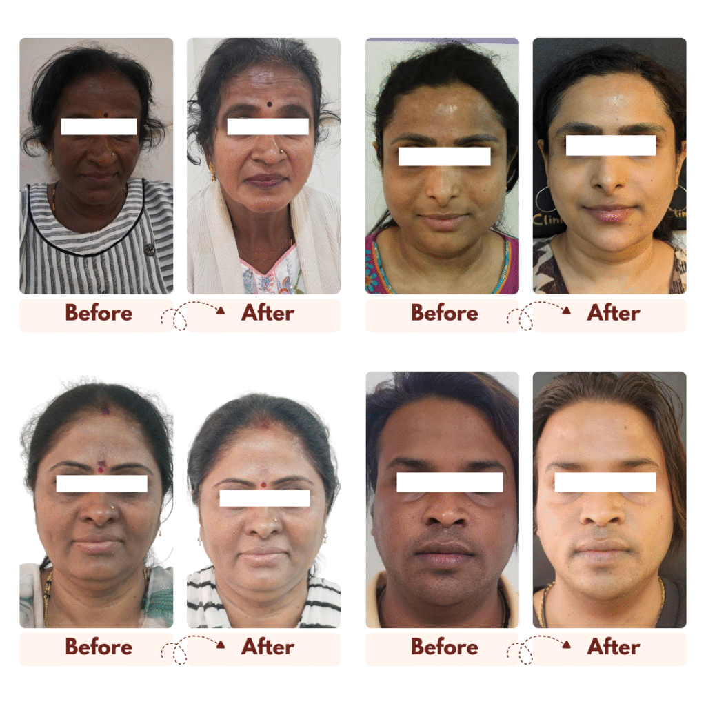 Pigmentation Removal Treatments 32 Befor After 2