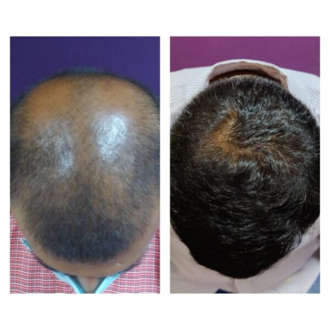 hair loss vs hair growth 2