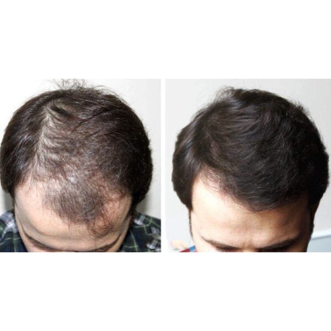 hair loss vs hair growth 5
