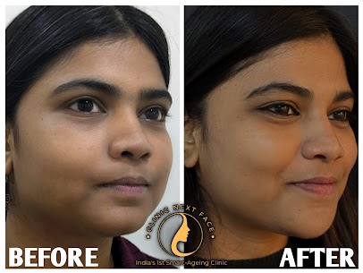 Chin Filler