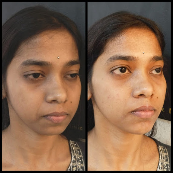 Dermal Filler Rejuvenition