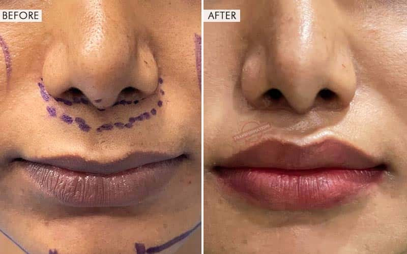 Lip Augmentation pic 4
