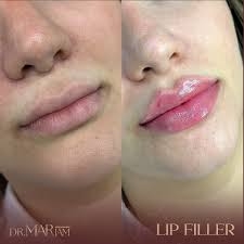 Lip Definition pic 5