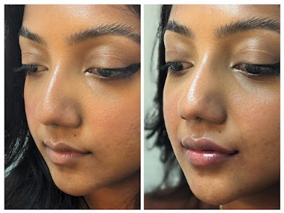 Lip Fillers 1